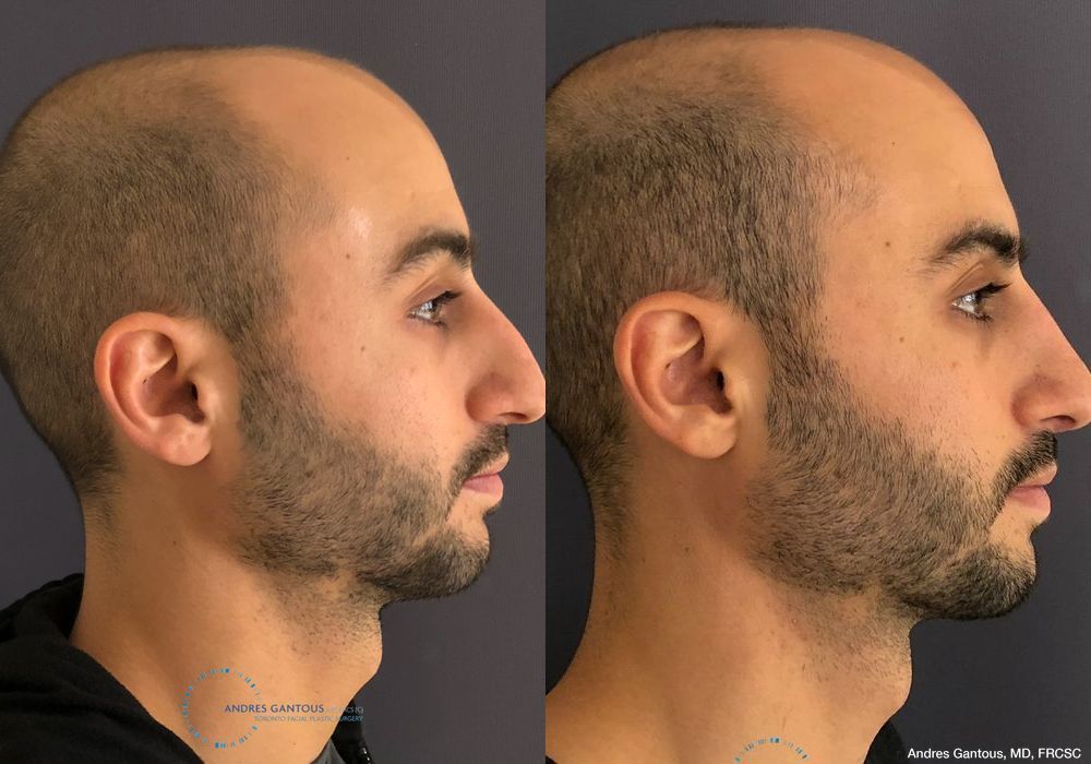 Rhinoplasty - Thumbnail 5