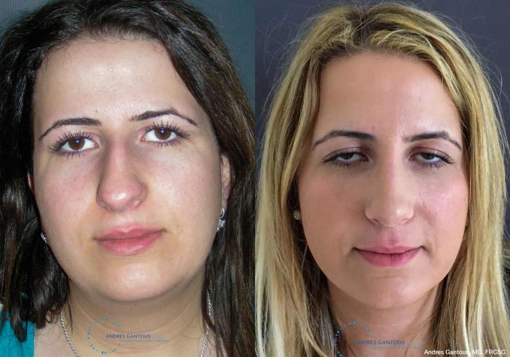 Rhinoplasty - Case 6748