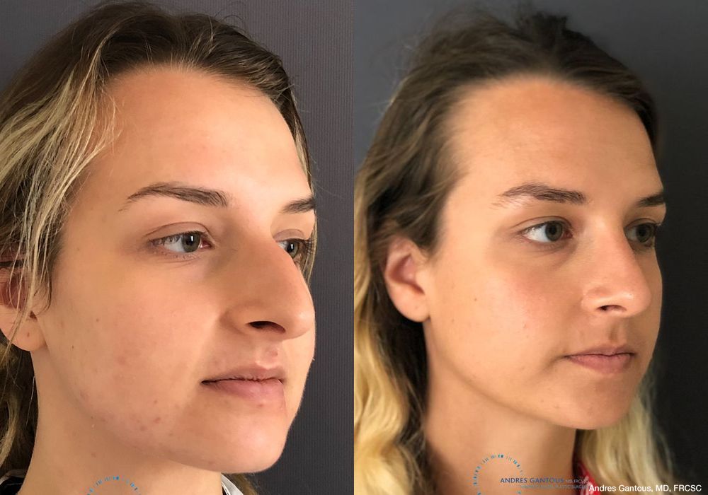 Rhinoplasty - Thumbnail 3