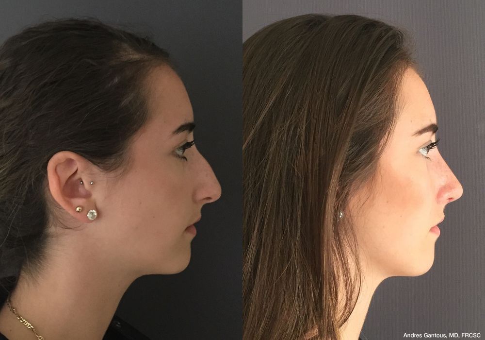 Rhinoplasty - Thumbnail 5