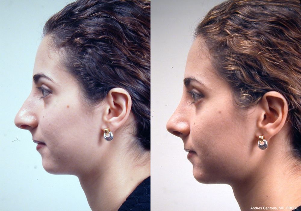 Rhinoplasty - Thumbnail 4