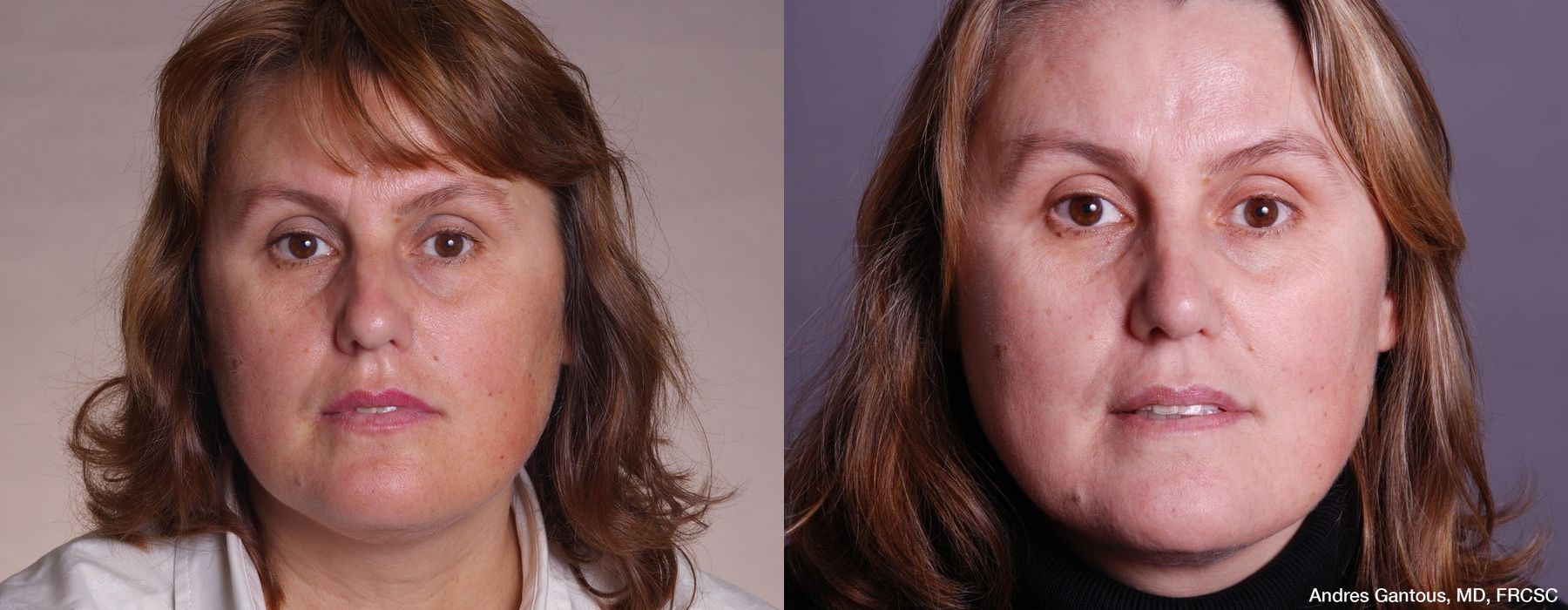 Rhinoplasty - Case 6705