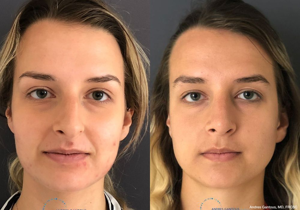 Rhinoplasty - Case 6744