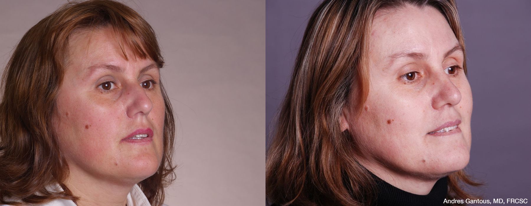 Rhinoplasty - Thumbnail 2