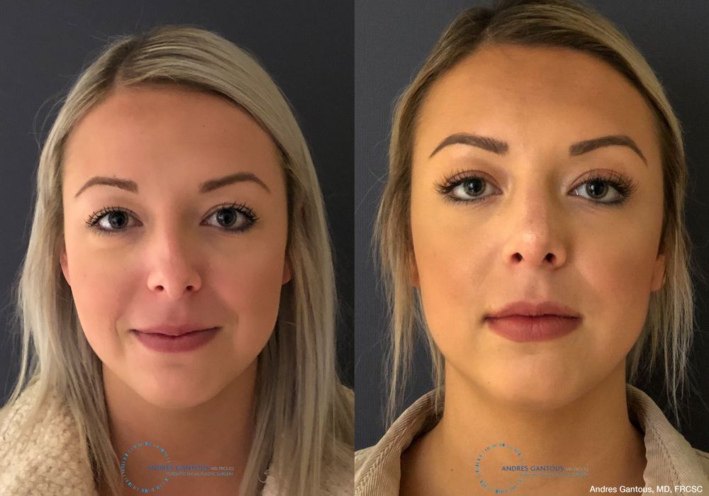 Rhinoplasty - Case 6727