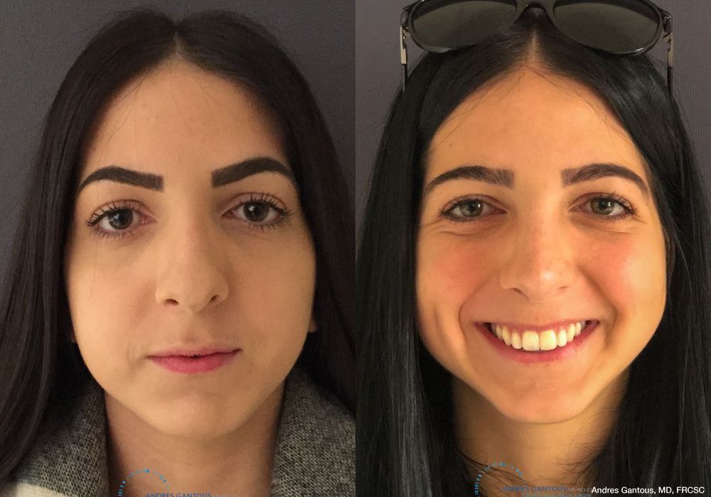 Rhinoplasty - Case 6521