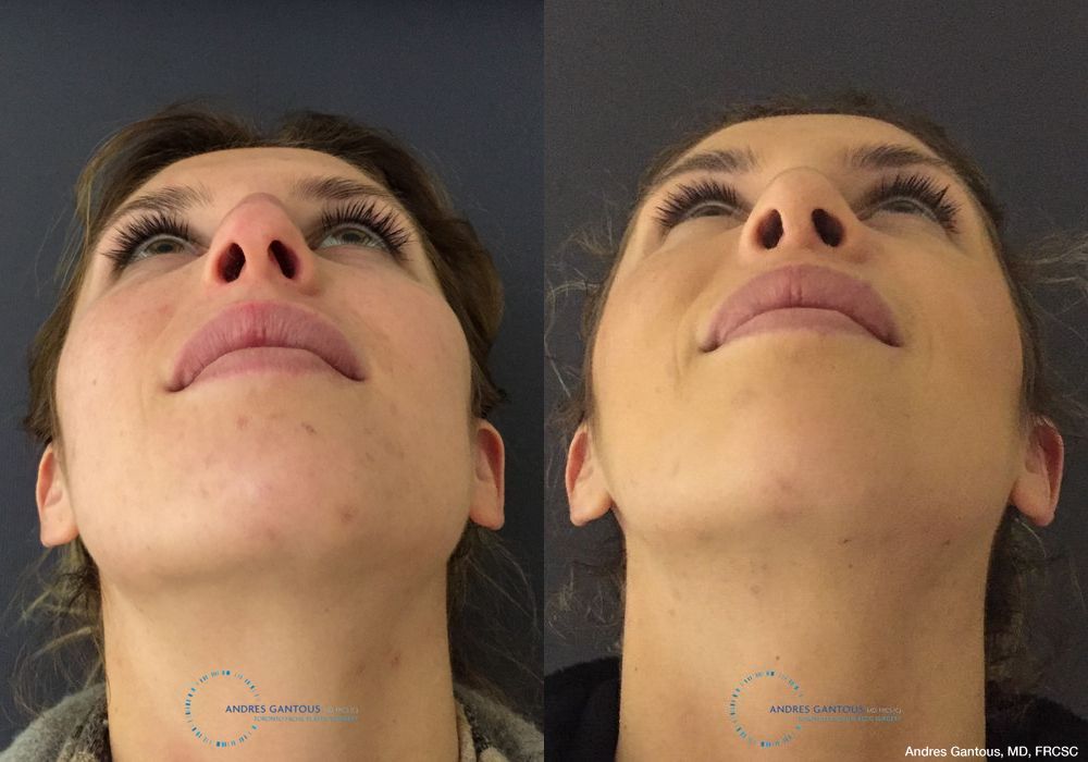Rhinoplasty - Thumbnail 2
