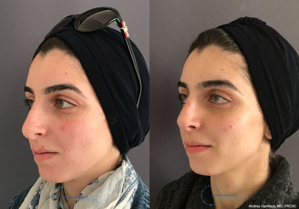 Rhinoplasty - Thumbnail 4