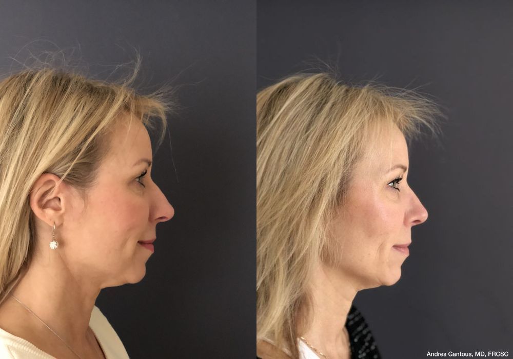 Rhinoplasty - Thumbnail 5