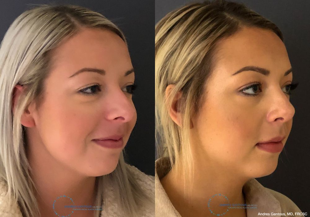 Rhinoplasty - Thumbnail 4