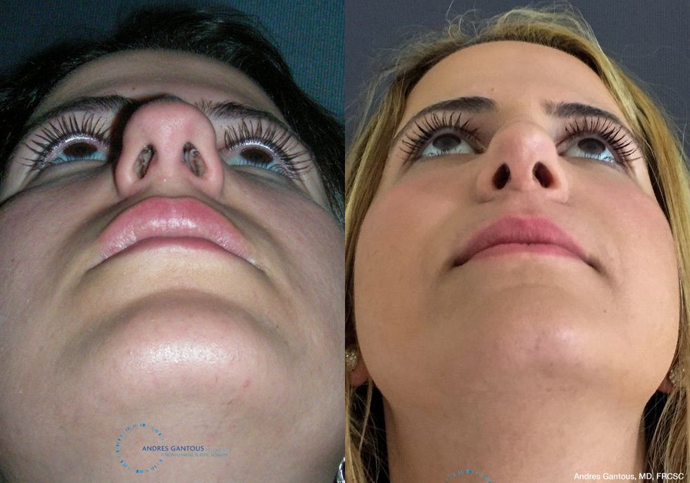 Rhinoplasty - Thumbnail 2