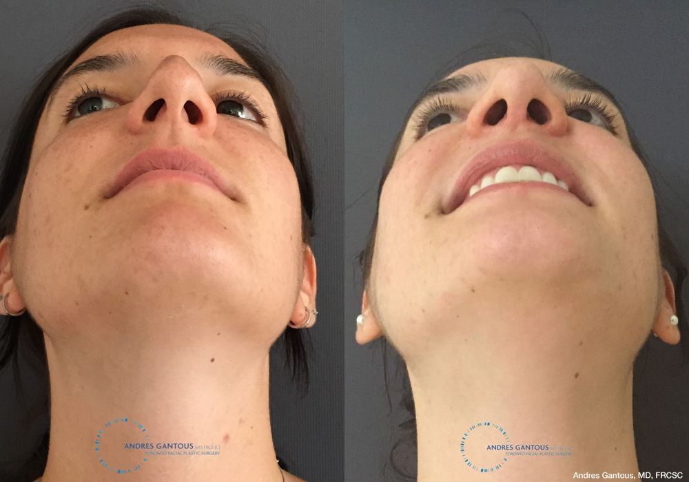 Rhinoplasty - Thumbnail 2