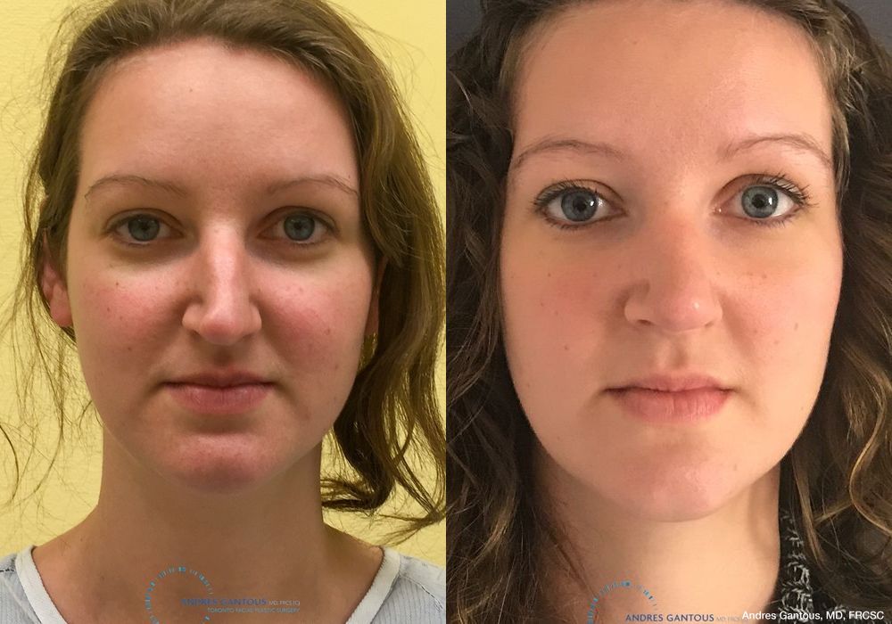 Rhinoplasty - Case 6720