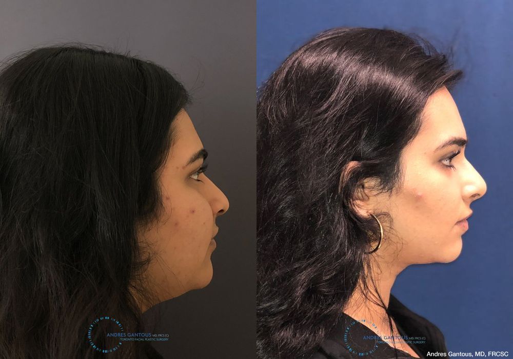 Rhinoplasty - Thumbnail 5