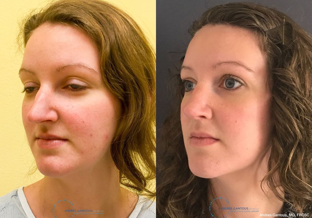 Rhinoplasty - Thumbnail 3