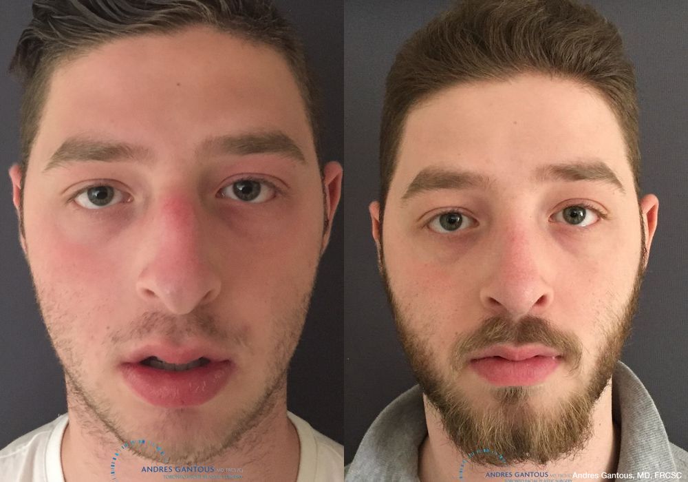 Rhinoplasty - Case 7184