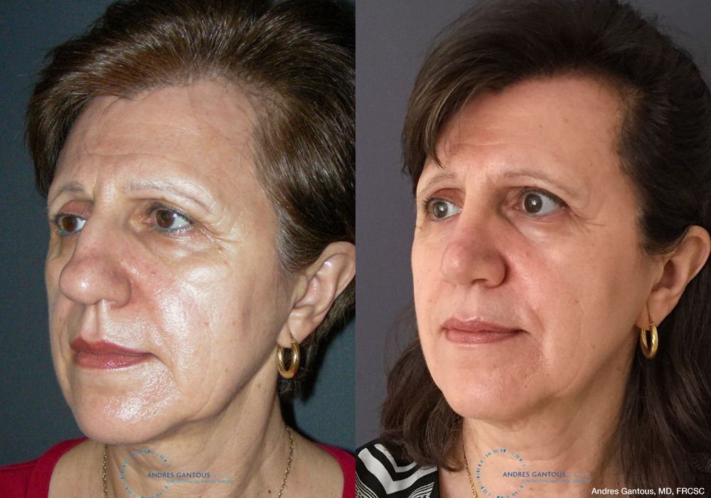 Rhinoplasty - Thumbnail 4