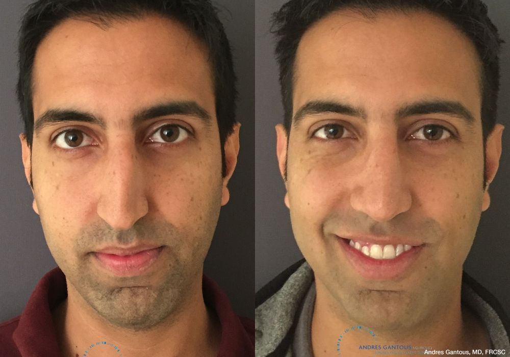 Rhinoplasty - Case 6510