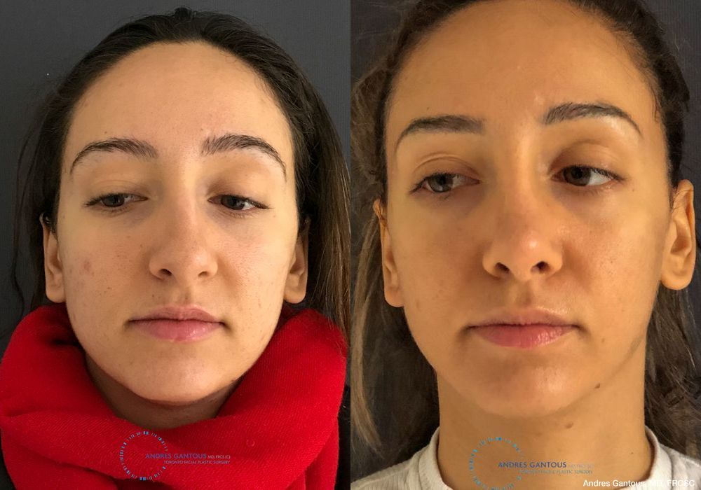 Rhinoplasty - Case 6717