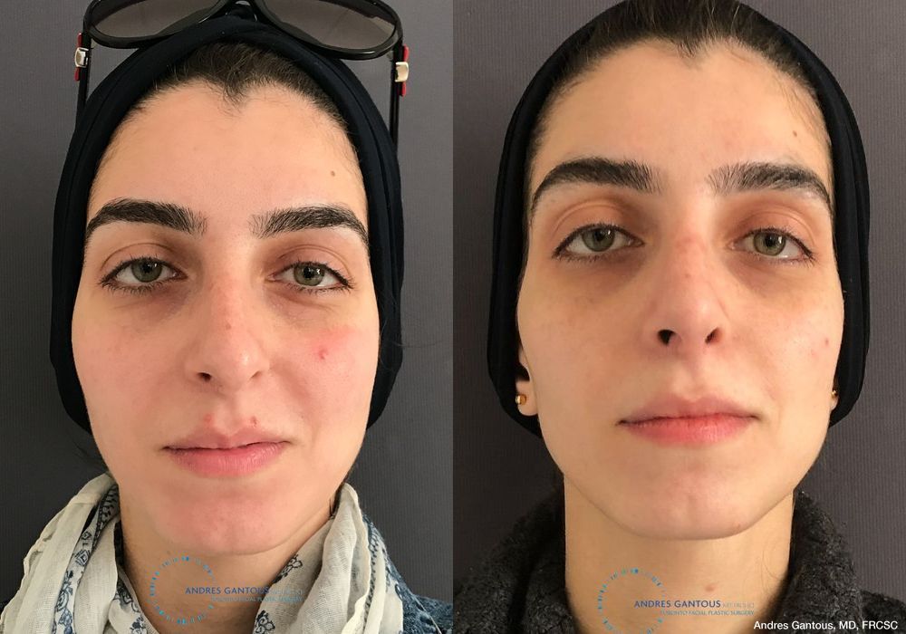Rhinoplasty - Case 6716