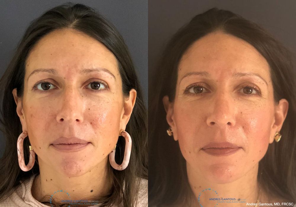 Rhinoplasty - Case 6436