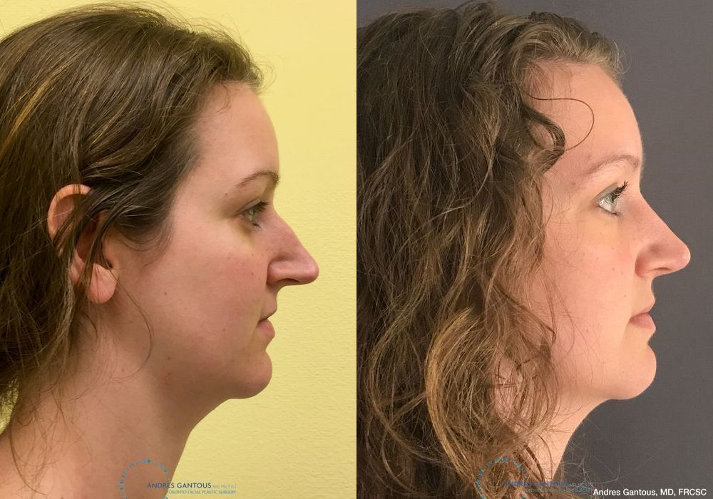 Rhinoplasty - Thumbnail 6