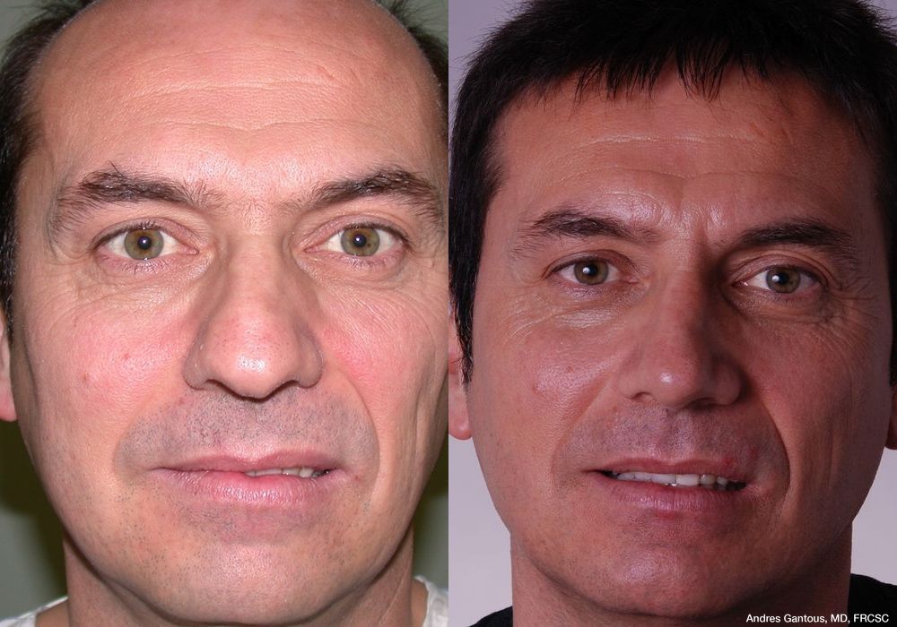 Rhinoplasty - Case 6434