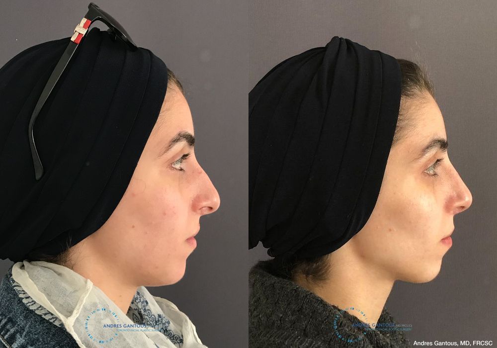 Rhinoplasty - Thumbnail 5