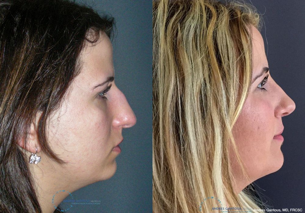 Rhinoplasty - Thumbnail 5