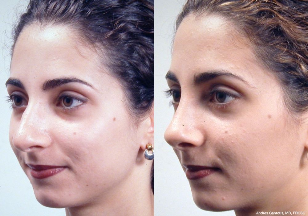 Rhinoplasty - Thumbnail 2