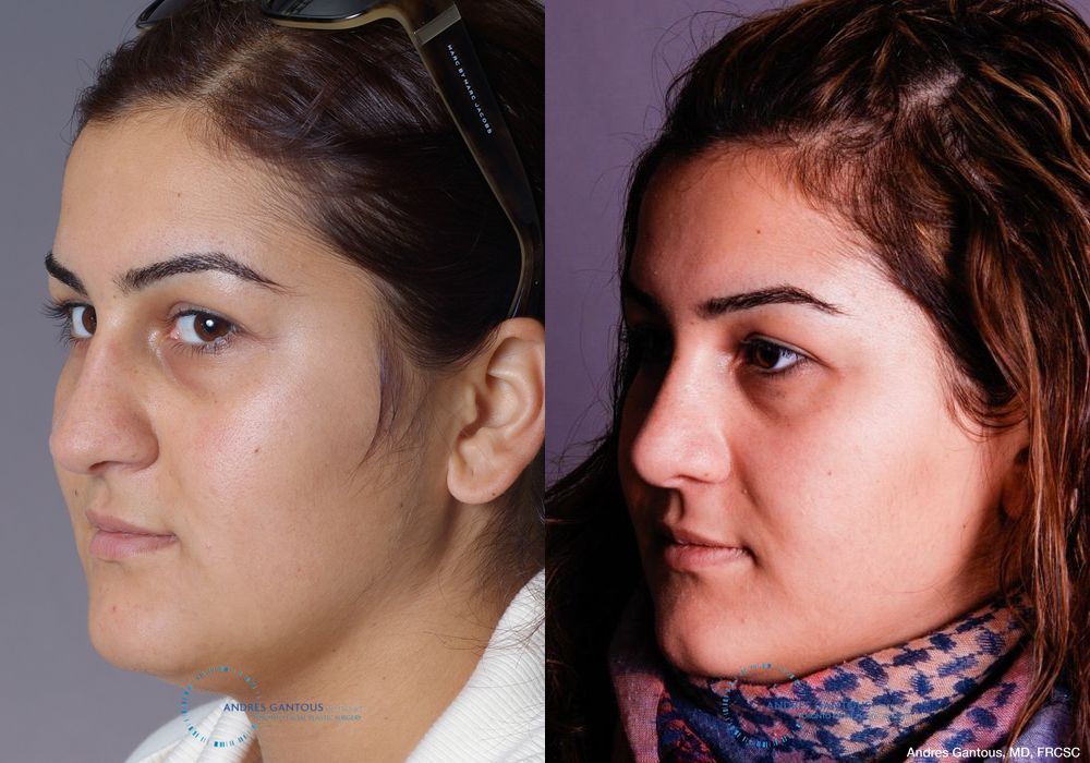 Rhinoplasty - Thumbnail 3