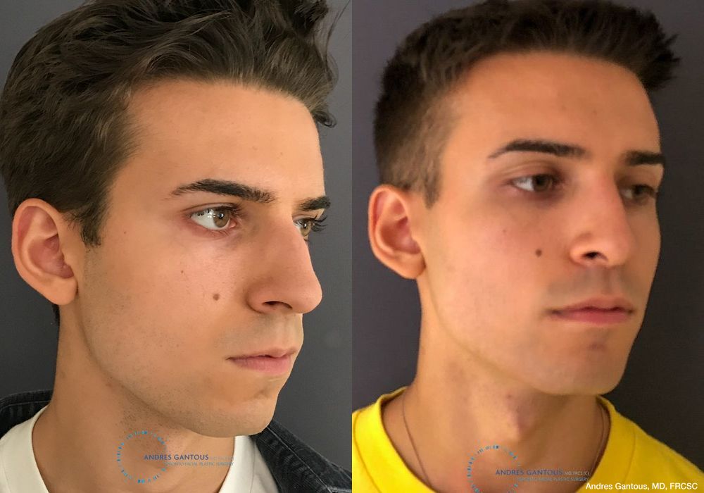 Rhinoplasty - Thumbnail 4