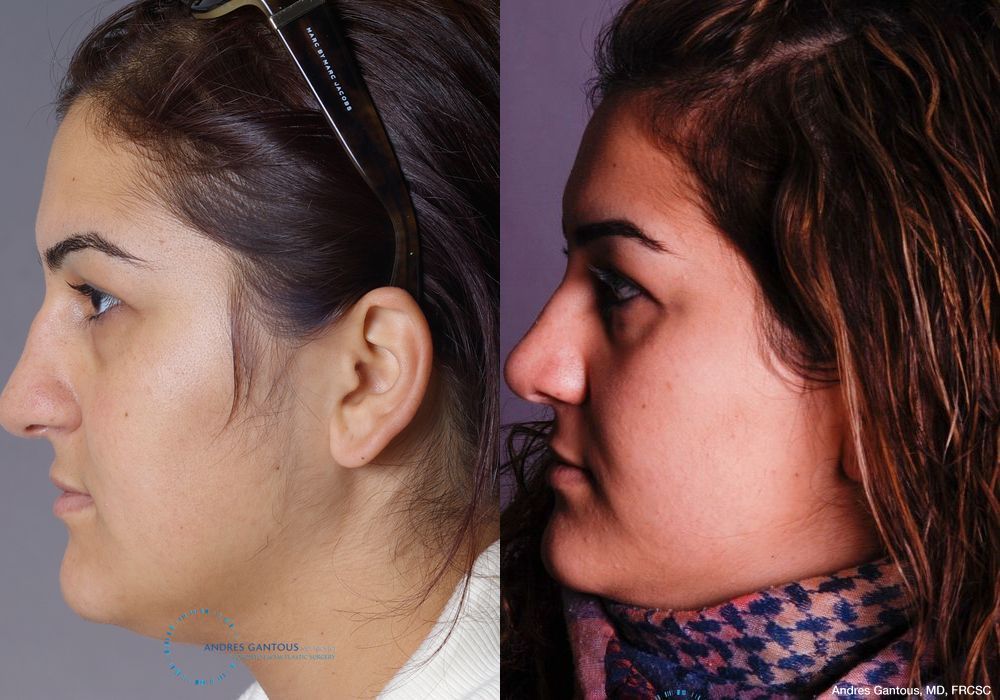 Rhinoplasty - Thumbnail 5