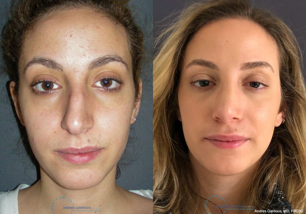 Rhinoplasty - Case 6494