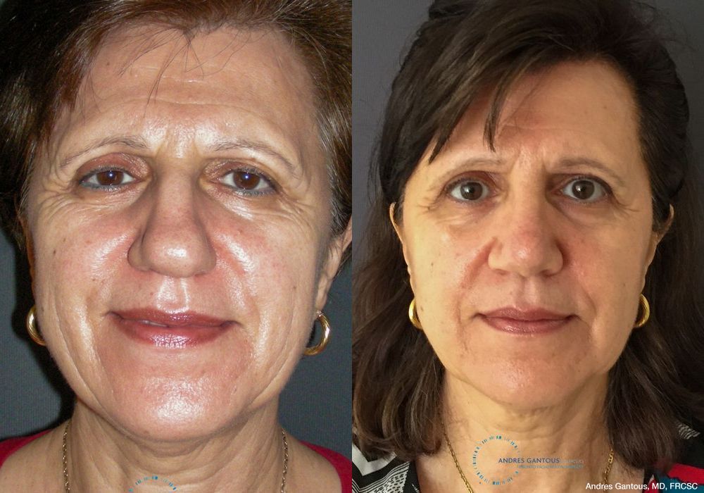 Rhinoplasty - Case 6751