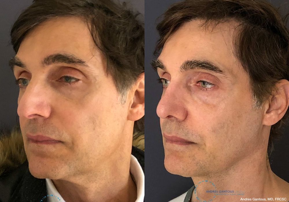 Rhinoplasty - Thumbnail 4