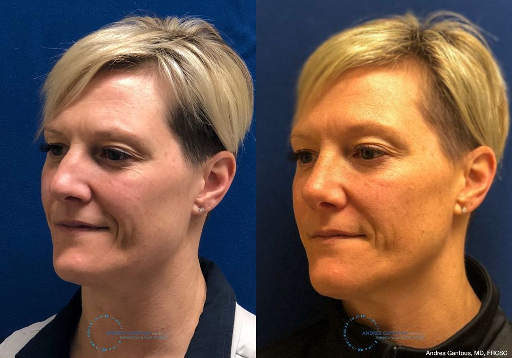 Rhinoplasty - Thumbnail 4