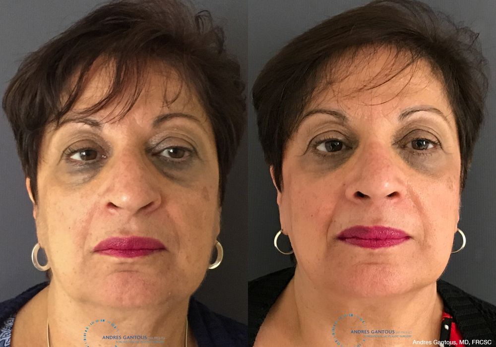 Rhinoplasty - Case 6747