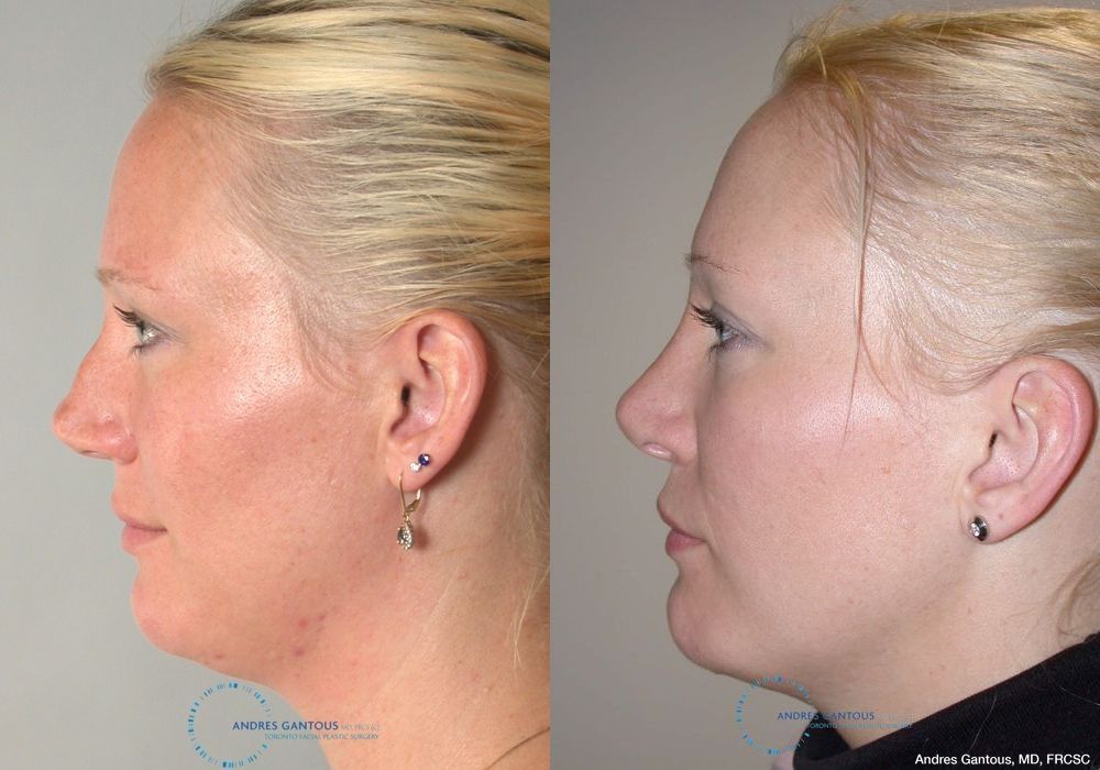 Rhinoplasty - Thumbnail 4