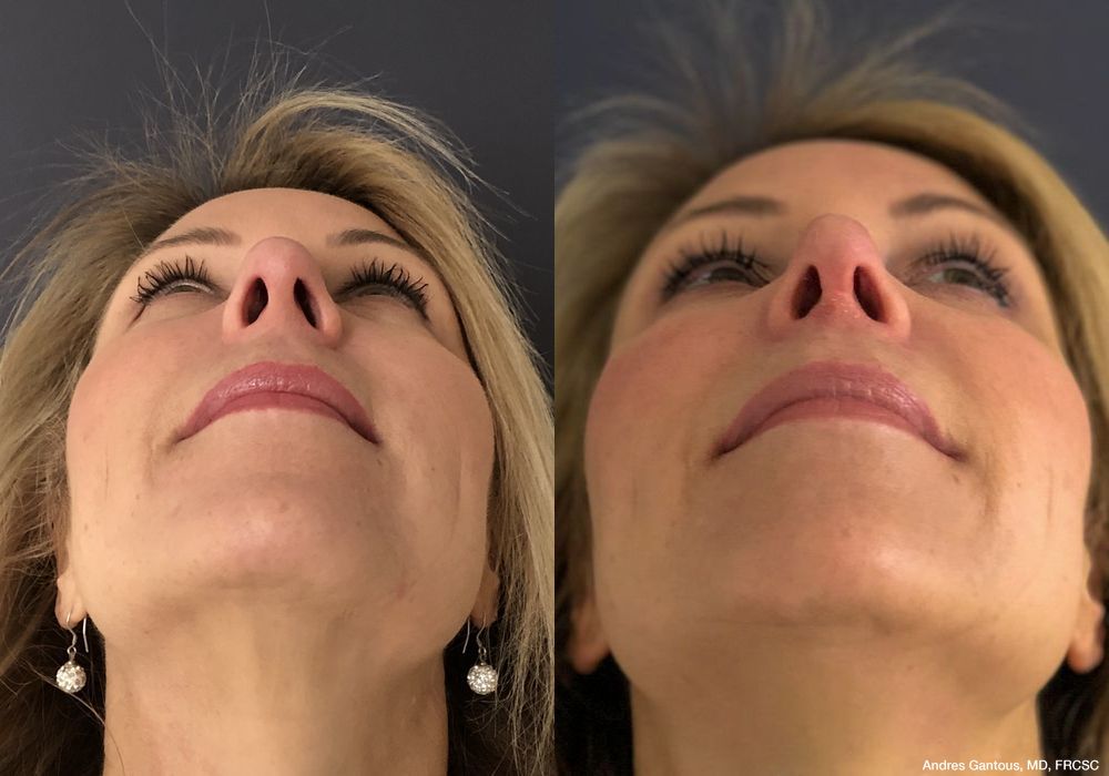 Rhinoplasty - Thumbnail 2