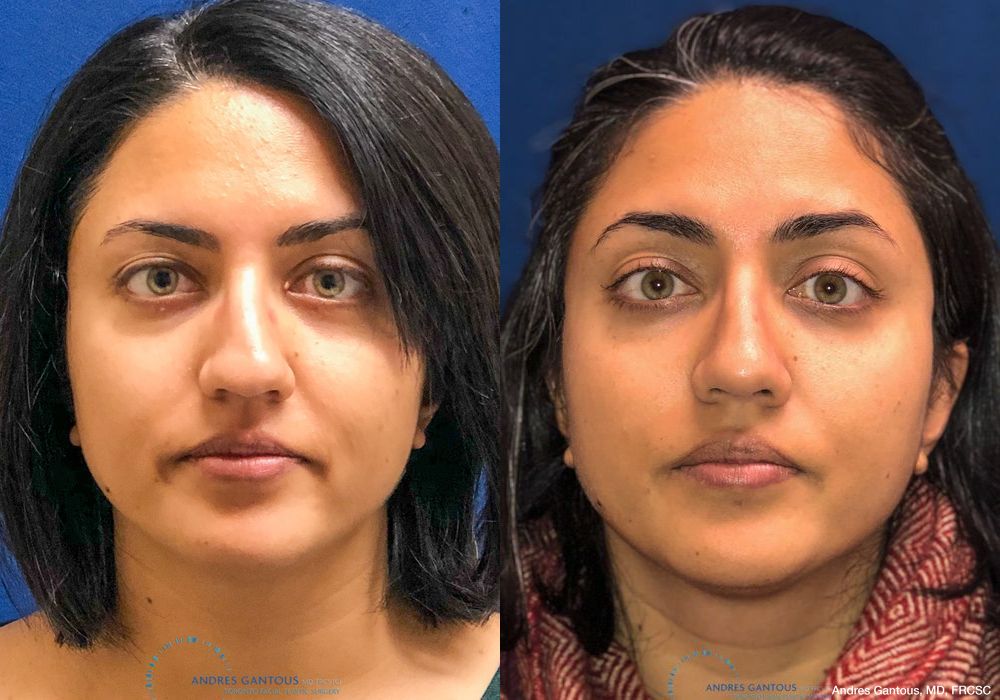 Rhinoplasty - Case 6738