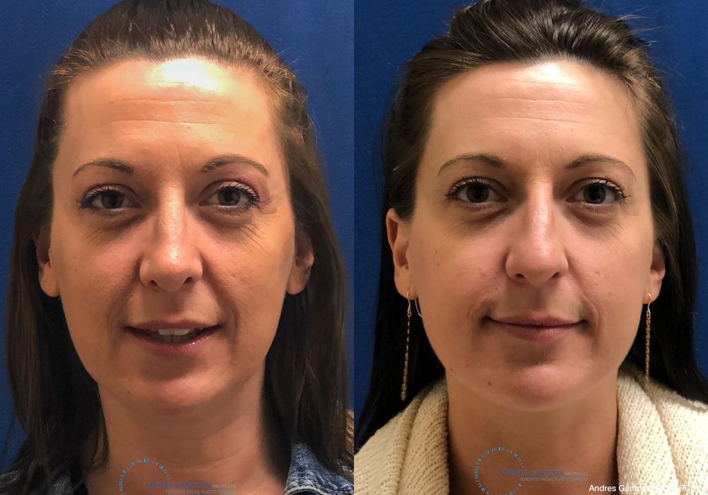 Rhinoplasty - Case 6683