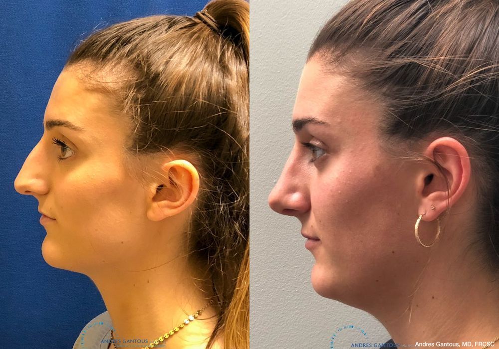 Rhinoplasty - Thumbnail 6