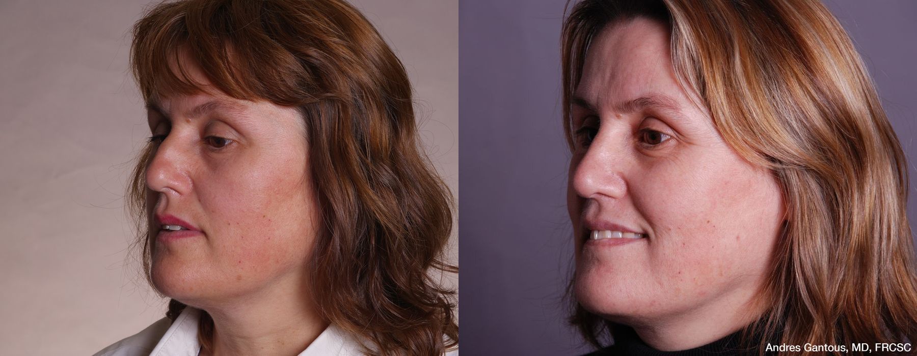 Rhinoplasty - Thumbnail 4