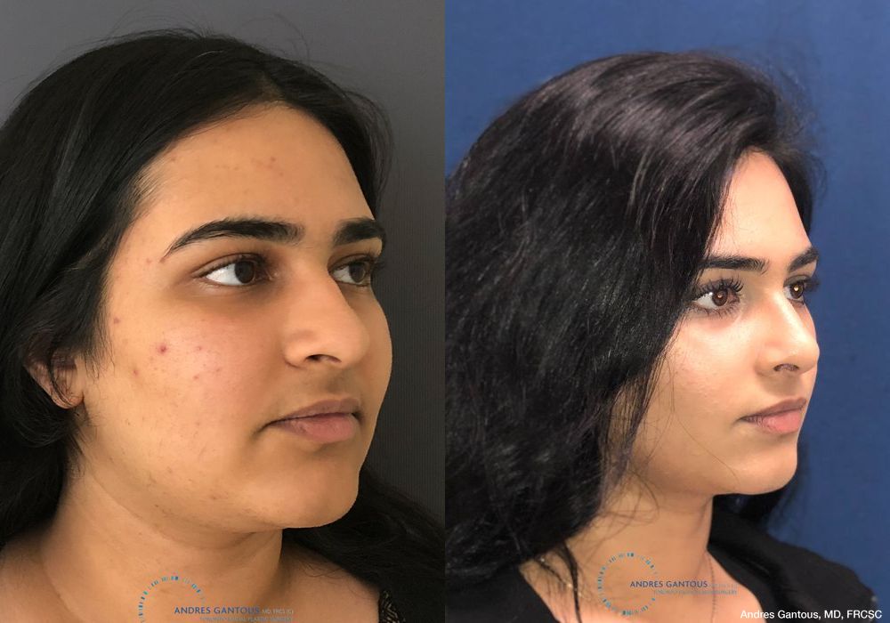 Rhinoplasty - Thumbnail 3