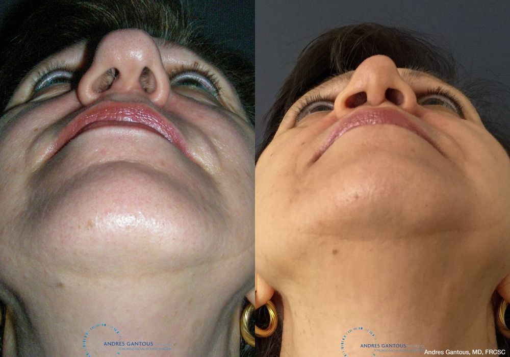 Rhinoplasty - Thumbnail 2