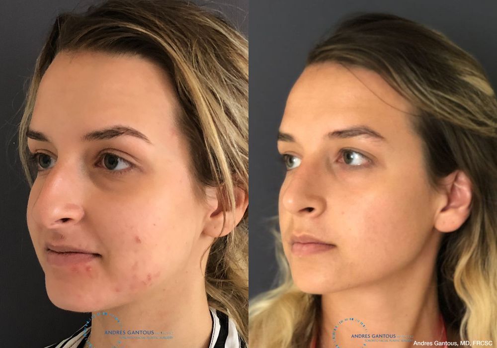 Rhinoplasty - Thumbnail 4