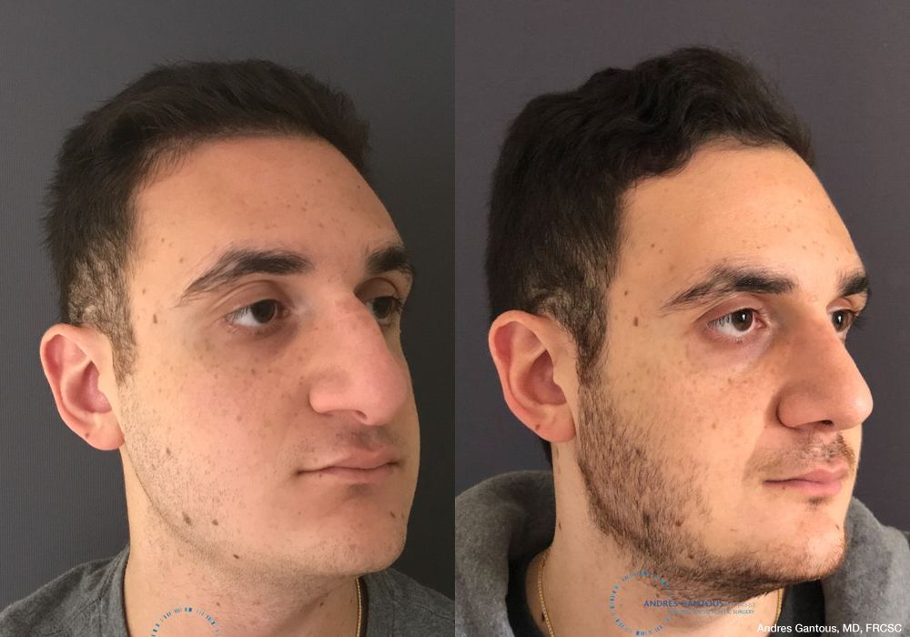 Rhinoplasty - Thumbnail 3