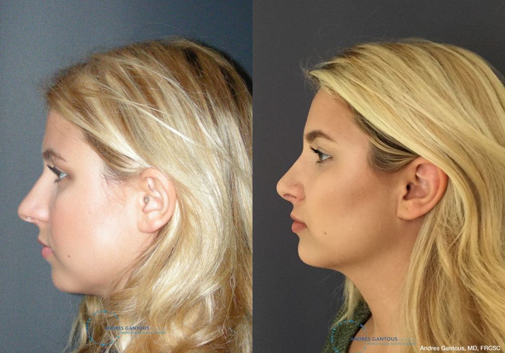 Rhinoplasty - Thumbnail 6