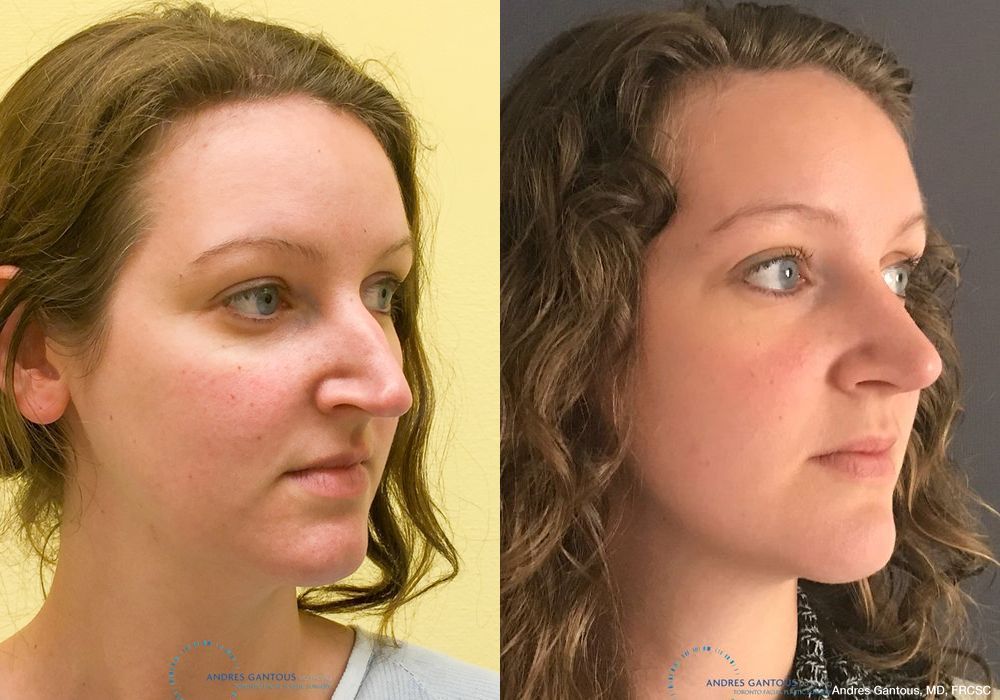 Rhinoplasty - Thumbnail 4